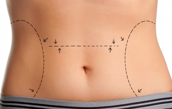 LIPOASPIRACIÓN LÁSER