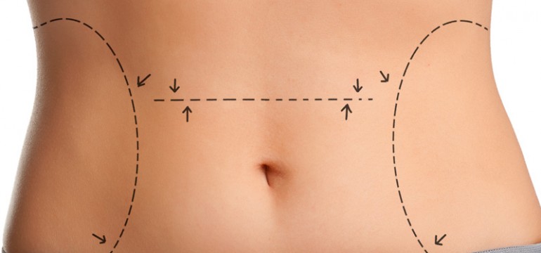 LIPOASPIRACIÓN LÁSER
