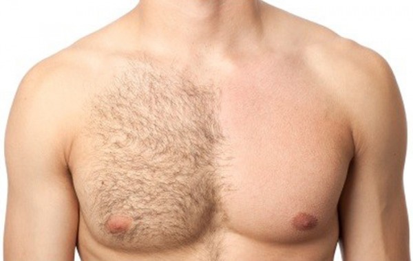 DESPILACIÓN LÁSER MASCULINA