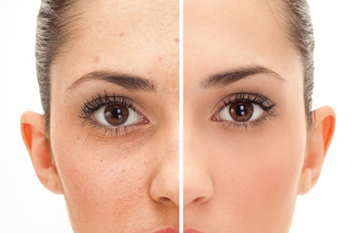CICATRIZ DE ACNE