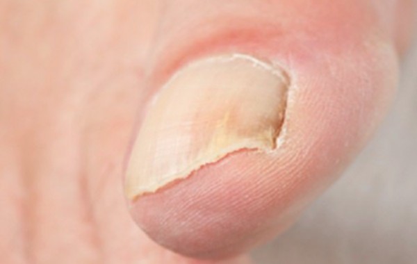 ONICOMICOSIS