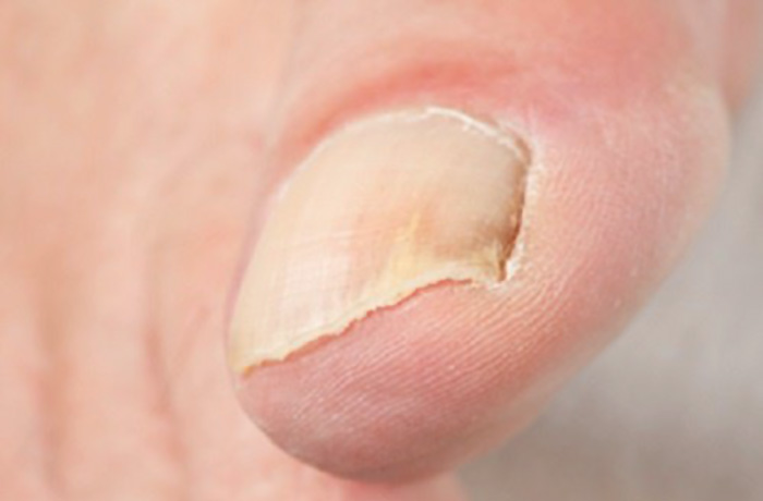 ONICOMICOSIS